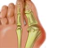大脚骨有什么症状？如何避免这些症状？