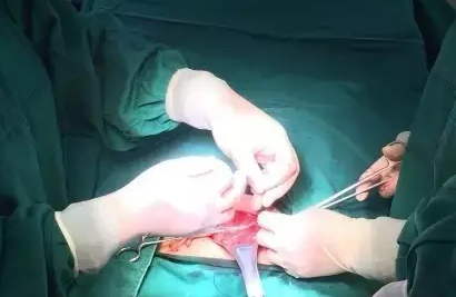 美容腹膜外剖宫产术